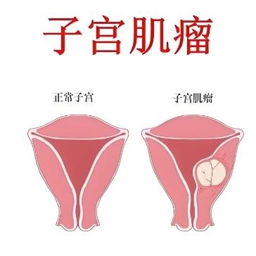 多囊肿卵巢综合症的原因是什么？