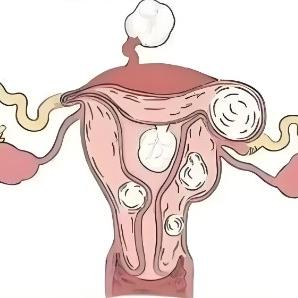 引发女性子宫肌瘤的原因是什么？