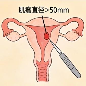 女性子宫肌瘤是如何造成的？