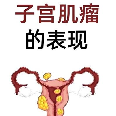 女性得了子宫肌瘤的症状表现有哪些？