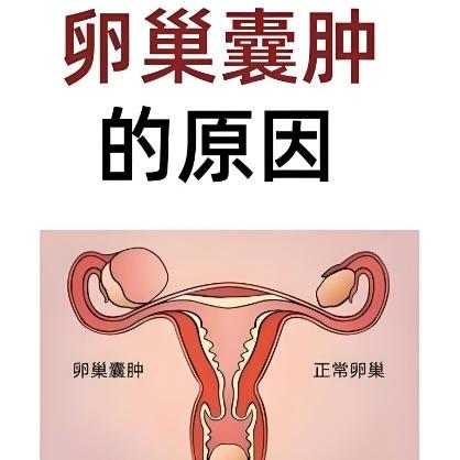 卵巢囊肿到底是怎么一回事呢？