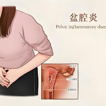 你知道盆腔炎具体是怎么引起的吗？