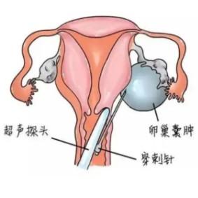 引起女性卵巢囊肿的几个原因是什么？