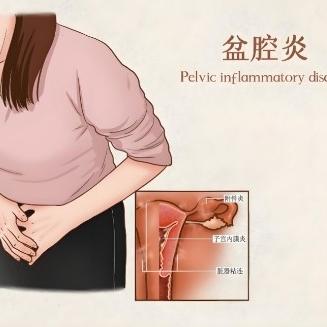 有哪些原因会引起女性出现盆腔炎？