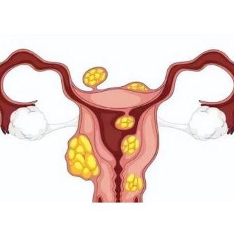 女性子宫肌瘤的症状表现具体是什么？