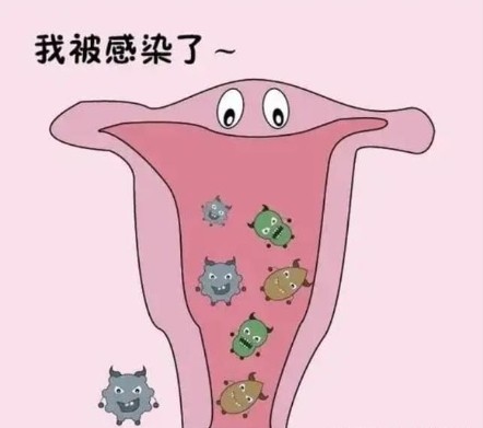 阴道炎1.jpg